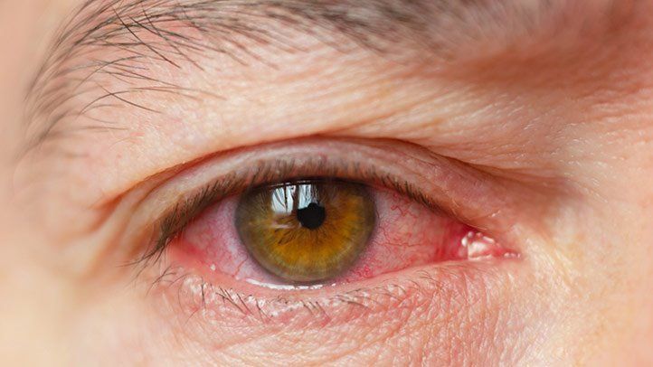 C:Userseeshan SiddiqueDesktopNew folderwhat-is-dry-eye-symptoms-treatment-causes-722x406.jpg